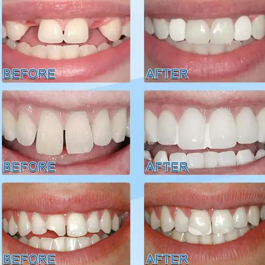 BUY 1, GET 1 FREE | SmileSaver Tooth Repair Duo